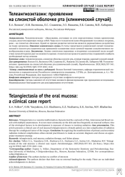 Телеангиоэктазии: проявление на слизистой оболочке рта (клинический случай)